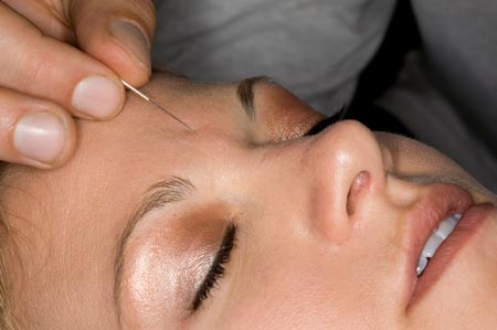 acupuntura2